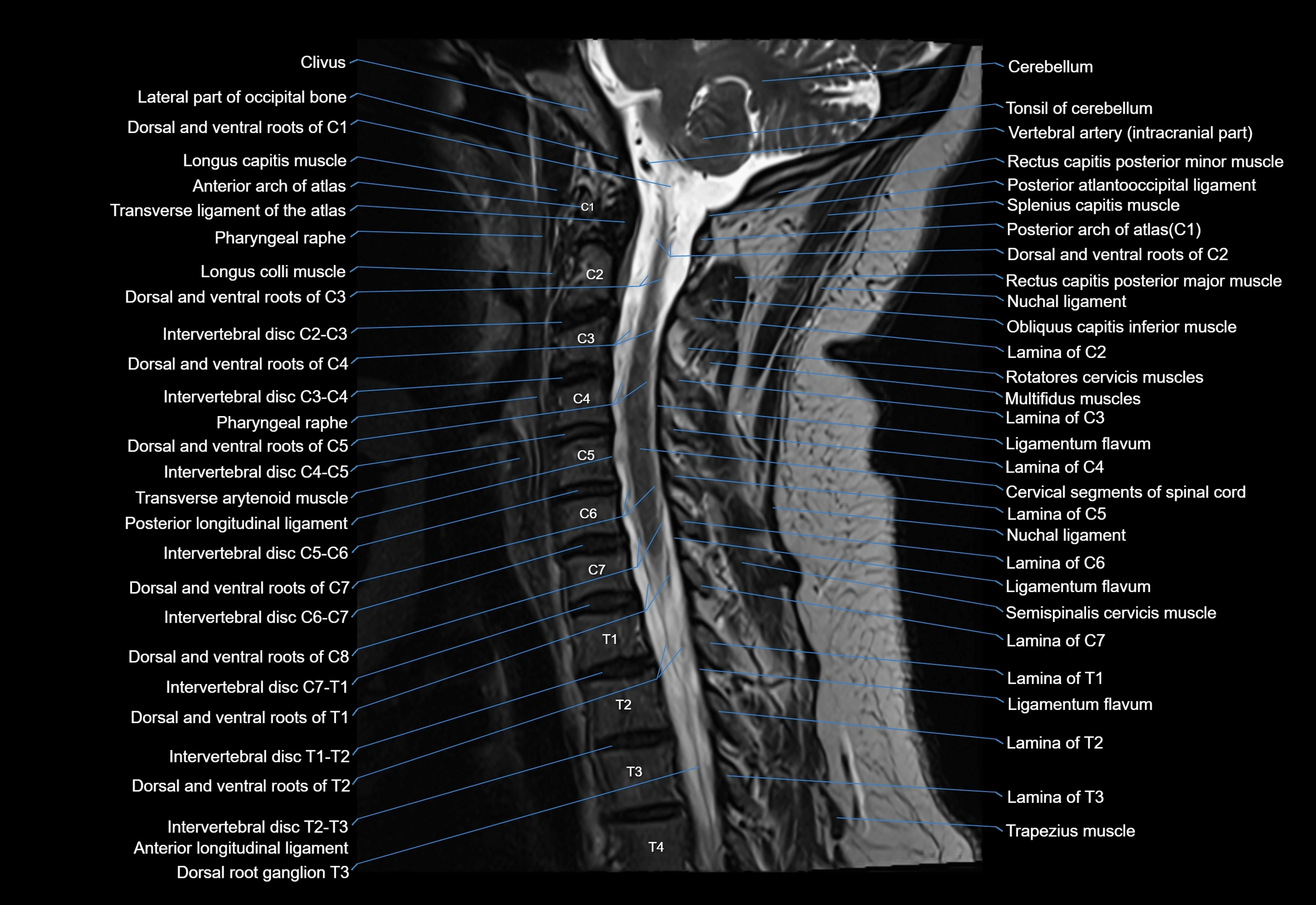 cervical spine cross sectional MRI anatomy 3T MRI  sagittal image-img-00001-00014.webp